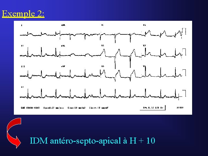 Exemple 2: IDM antéro-septo-apical à H + 10 Exemple 2: IDM antéro-septo-apical à H + 10