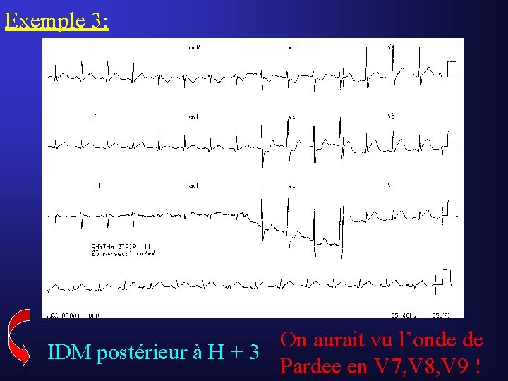 Exemple 3: On aurait vu l’onde de IDM postérieur à H + 3 Pardee Exemple 3: On aurait vu l’onde de IDM postérieur à H + 3 Pardee