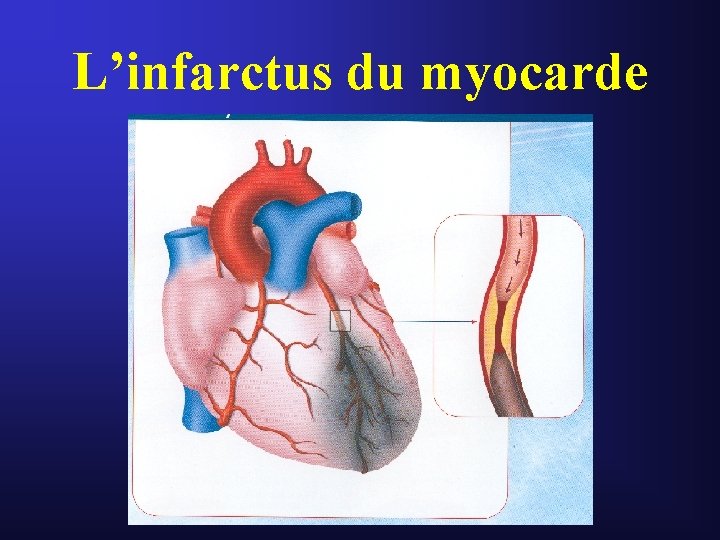 L’infarctus du myocarde L’infarctus du myocarde