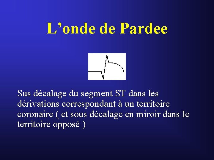 L’onde de Pardee Sus décalage du segment ST dans les dérivations correspondant à un L’onde de Pardee Sus décalage du segment ST dans les dérivations correspondant à un