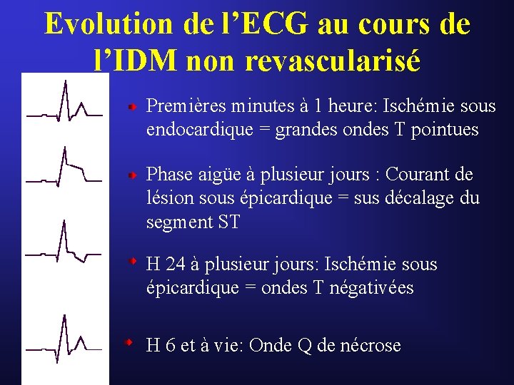 Evolution de l’ECG au cours de l’IDM non revascularisé Premières minutes à 1 heure: Evolution de l’ECG au cours de l’IDM non revascularisé Premières minutes à 1 heure: