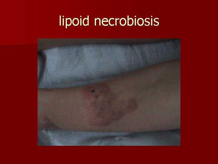 lipoid necrobiosis diabetes)