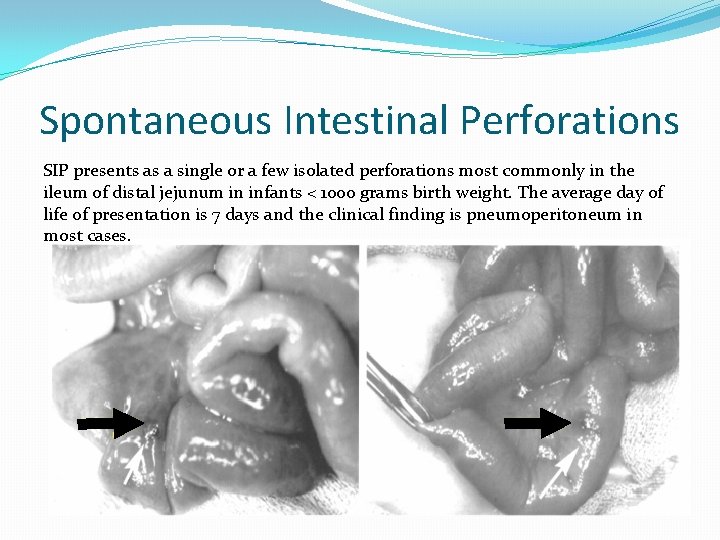 Spontaneous Intestinal Perforations SIP presents as a single or a few isolated perforations most