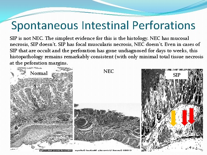 Spontaneous Intestinal Perforations SIP is not NEC. The simplest evidence for this is the