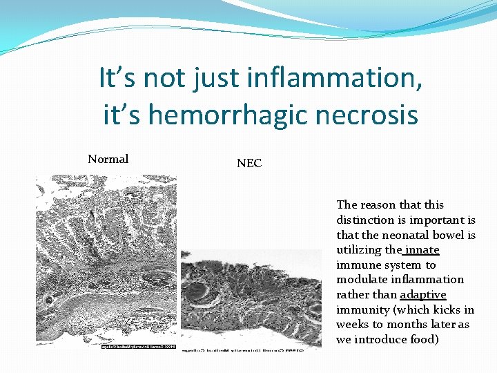 It’s not just inflammation, it’s hemorrhagic necrosis Normal NEC The reason that this distinction It’s not just inflammation, it’s hemorrhagic necrosis Normal NEC The reason that this distinction