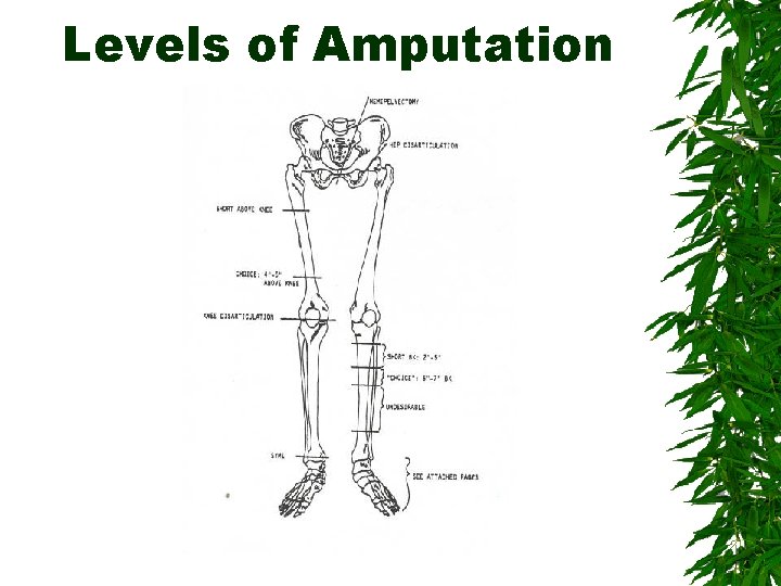 Levels of Amputation 