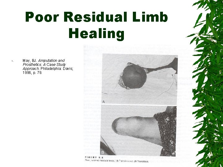 Poor Residual Limb Healing 1. May, BJ. Amputation and Prosthetics: A Case Study Approach.