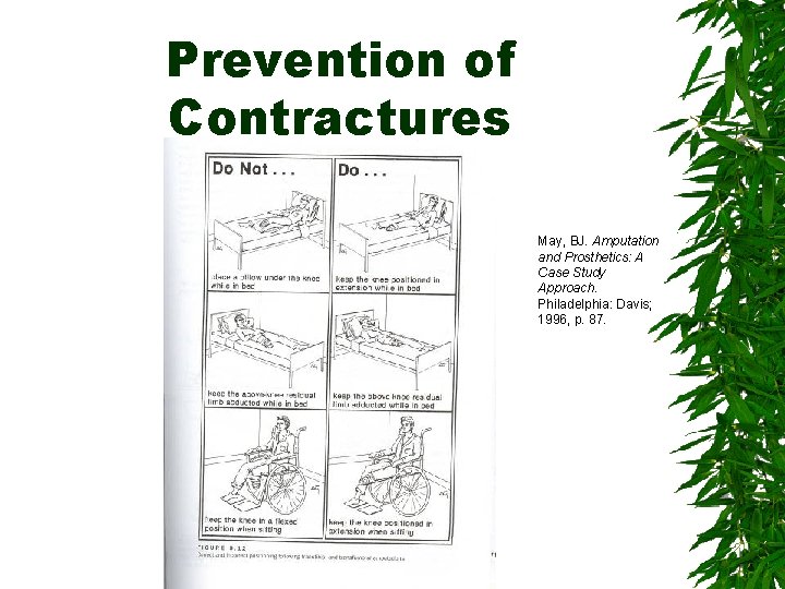 Prevention of Contractures May, BJ. Amputation and Prosthetics: A Case Study Approach. Philadelphia: Davis;