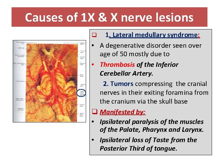 Causes of 1 X & X nerve lesions 1. Lateral medullary syndrome: • A