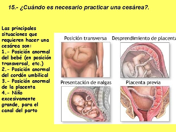 15. - ¿Cuándo es necesario practicar una cesárea? . Las principales situaciones que requieren
