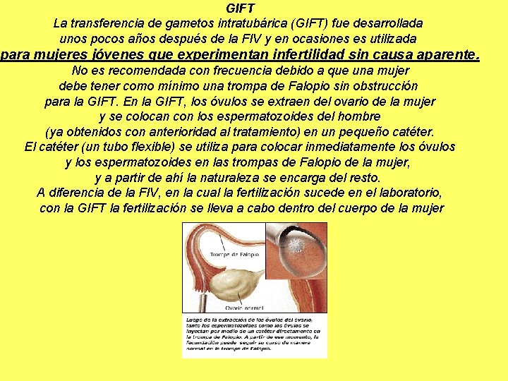 GIFT La transferencia de gametos intratubárica (GIFT) fue desarrollada unos pocos años después de