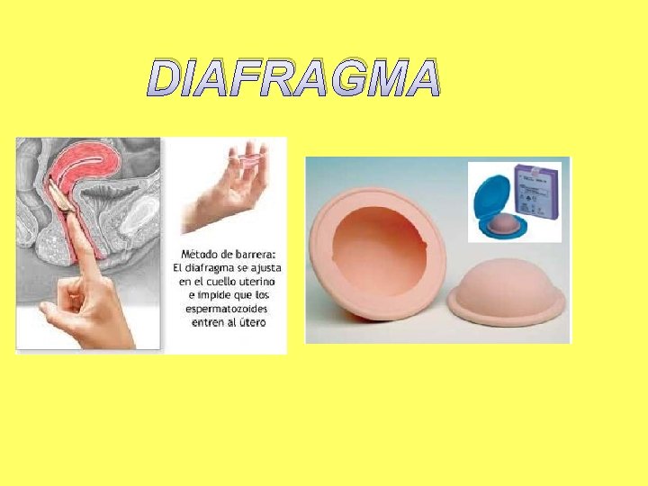 DIAFRAGMA 