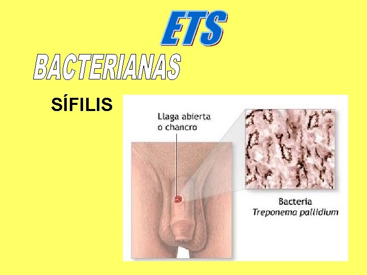 SÍFILIS 