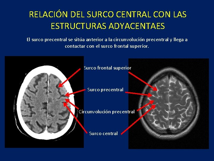 RELACIÓN DEL SURCO CENTRAL CON LAS ESTRUCTURAS ADYACENTAES El surco precentral se sitúa anterior