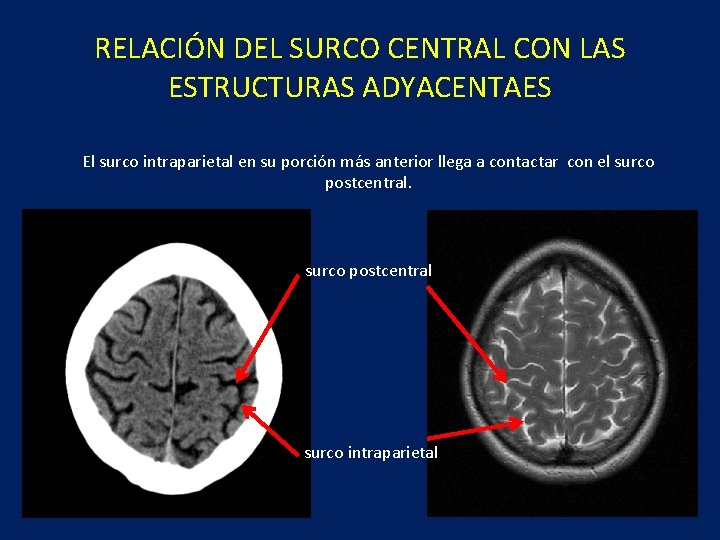 RELACIÓN DEL SURCO CENTRAL CON LAS ESTRUCTURAS ADYACENTAES El surco intraparietal en su porción