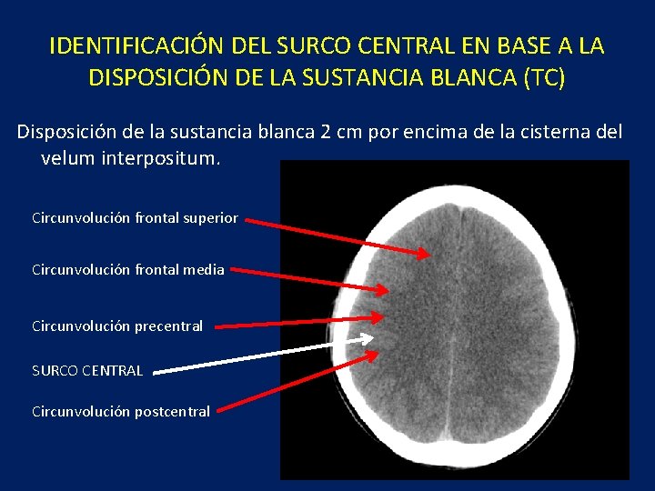 IDENTIFICACIÓN DEL SURCO CENTRAL EN BASE A LA DISPOSICIÓN DE LA SUSTANCIA BLANCA (TC)