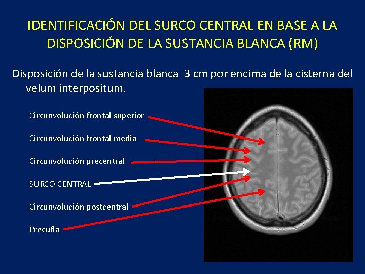 IDENTIFICACIÓN DEL SURCO CENTRAL EN BASE A LA DISPOSICIÓN DE LA SUSTANCIA BLANCA (RM)