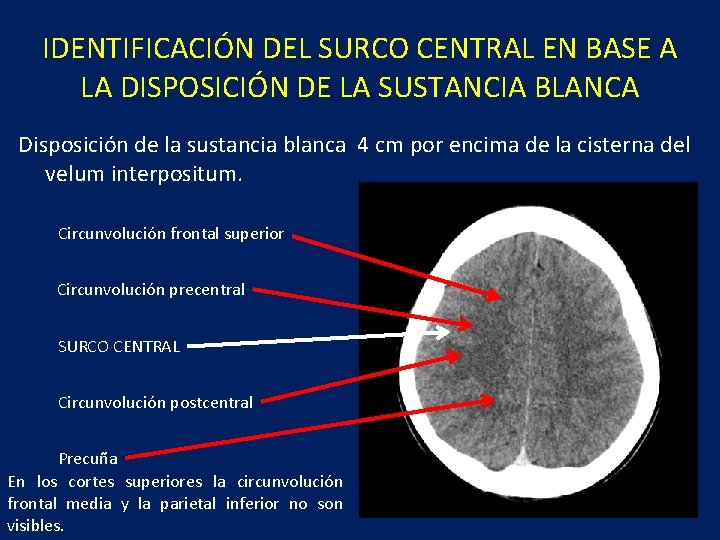 IDENTIFICACIÓN DEL SURCO CENTRAL EN BASE A LA DISPOSICIÓN DE LA SUSTANCIA BLANCA Disposición