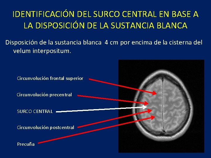 IDENTIFICACIÓN DEL SURCO CENTRAL EN BASE A LA DISPOSICIÓN DE LA SUSTANCIA BLANCA Disposición