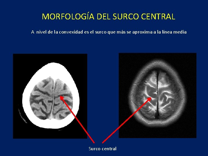  MORFOLOGÍA DEL SURCO CENTRAL A nivel de la convexidad es el surco que