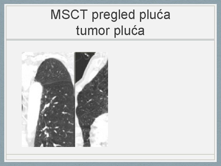 MSCT pregled pluća tumor pluća 