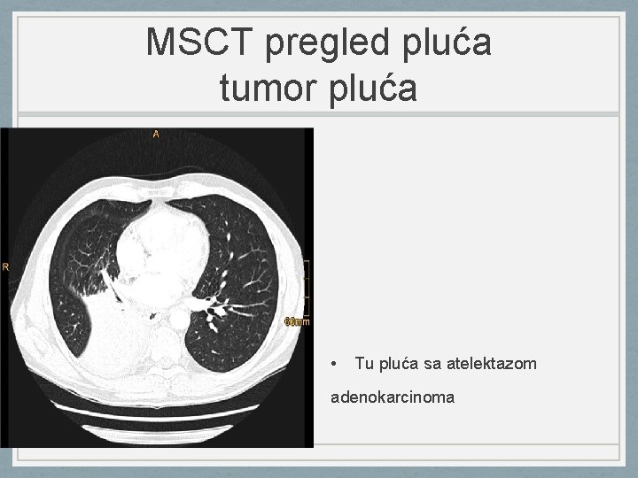 MSCT pregled pluća tumor pluća • Tu pluća sa atelektazom adenokarcinoma 