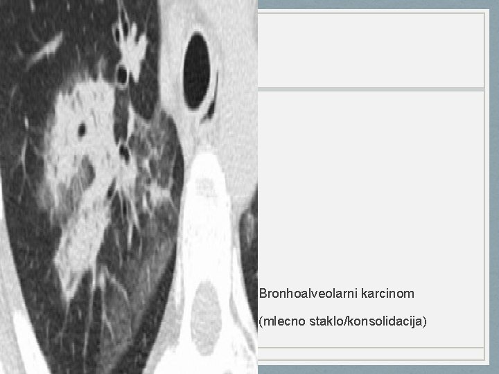 Bronhoalveolarni karcinom (mlecno staklo/konsolidacija) 