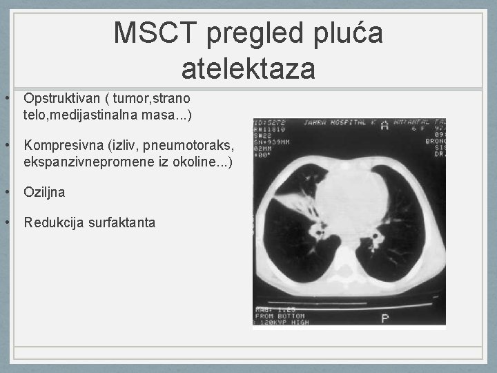 MSCT pregled pluća atelektaza • Opstruktivan ( tumor, strano telo, medijastinalna masa. . .