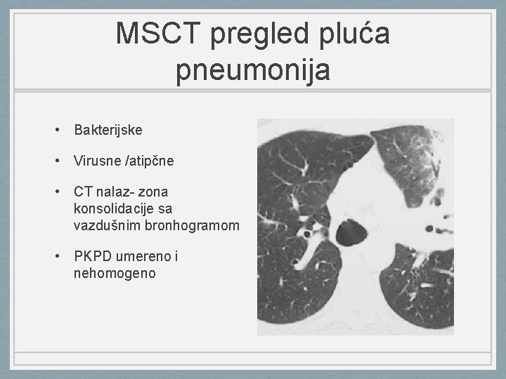 MSCT pregled pluća pneumonija • Bakterijske • Virusne /atipčne • CT nalaz- zona konsolidacije
