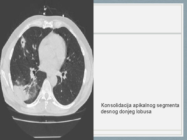 Konsolidacija apikalnog segmenta desnog donjeg lobusa 