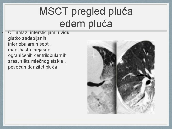 MSCT pregled pluća edem pluća • CT nalaz- intersticijum u vidu glatko zadebljanih interlobularnih