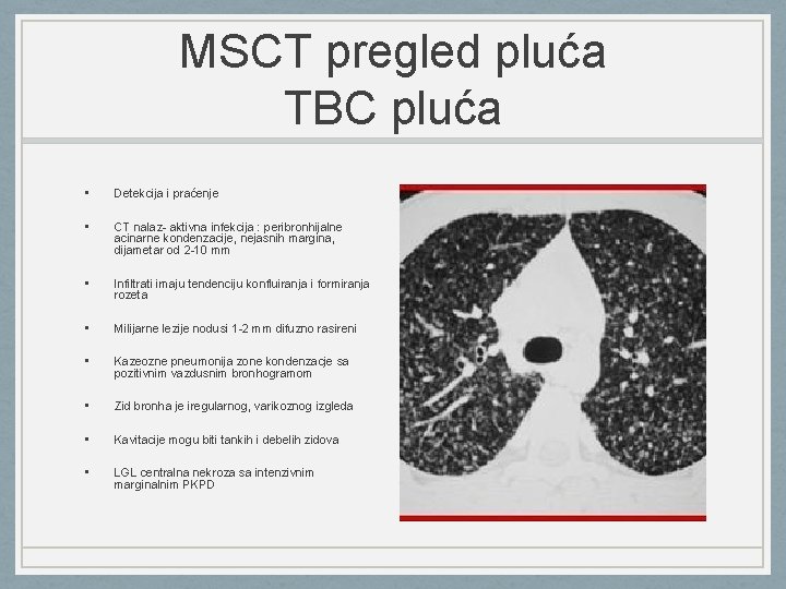 MSCT pregled pluća TBC pluća • Detekcija i praćenje • CT nalaz- aktivna infekcija