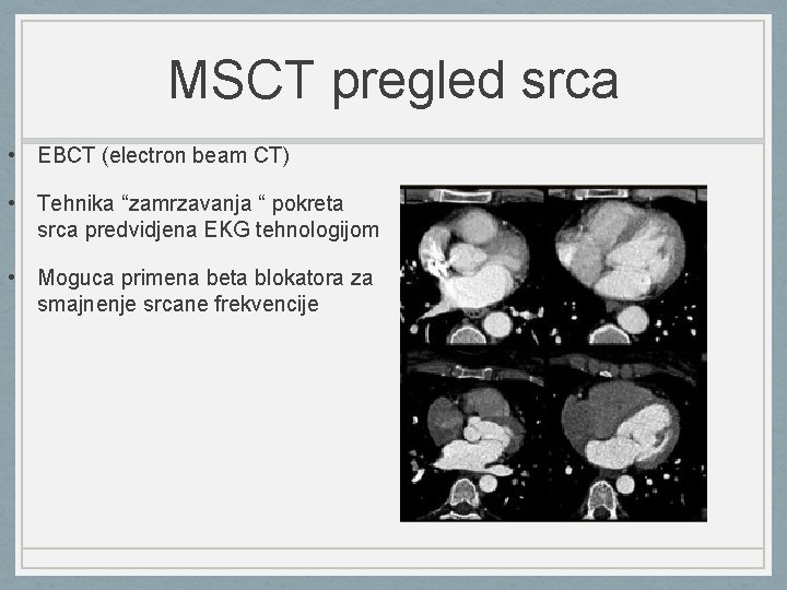 MSCT pregled srca • EBCT (electron beam CT) • Tehnika “zamrzavanja “ pokreta srca