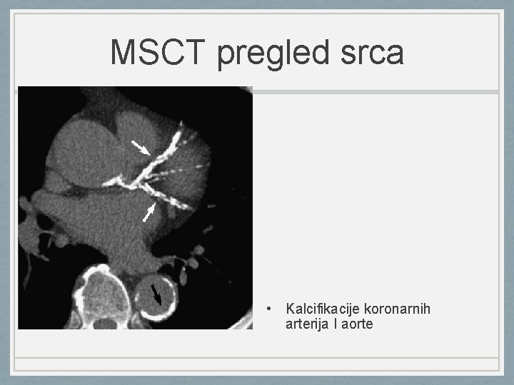 MSCT pregled srca • Kalcifikacije koronarnih arterija I aorte 