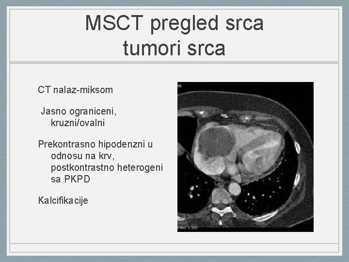 MSCT pregled srca tumori srca CT nalaz-miksom Jasno ograniceni, kruzni/ovalni Prekontrasno hipodenzni u odnosu