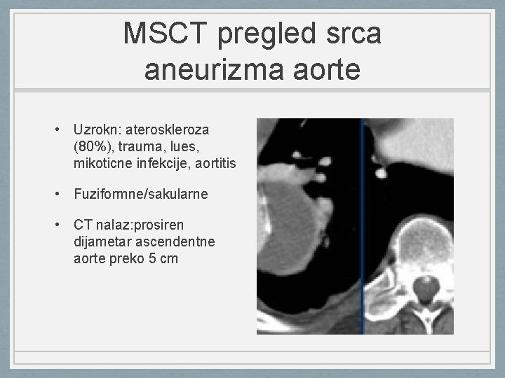 MSCT pregled srca aneurizma aorte • Uzrokn: ateroskleroza (80%), trauma, lues, mikoticne infekcije, aortitis
