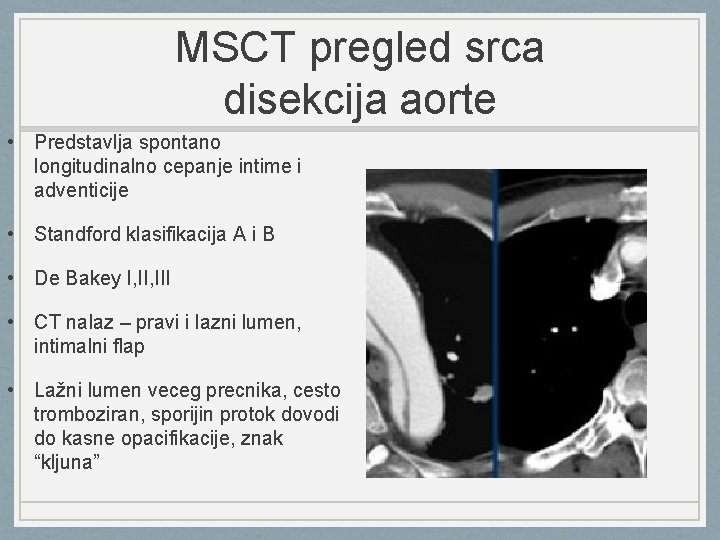 MSCT pregled srca disekcija aorte • Predstavlja spontano longitudinalno cepanje intime i adventicije •