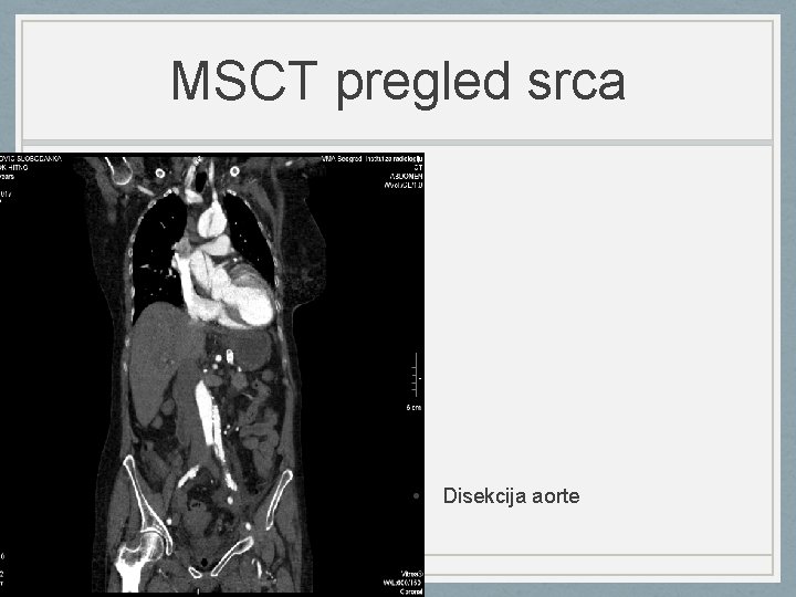 MSCT pregled srca • Disekcija aorte 