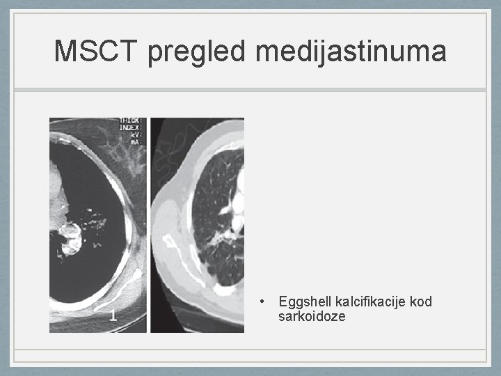 MSCT pregled medijastinuma • Eggshell kalcifikacije kod sarkoidoze 