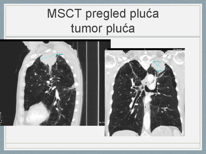 MSCT pregled pluća tumor pluća 