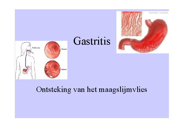 Gastritis Ontsteking van het maagslijmvlies 