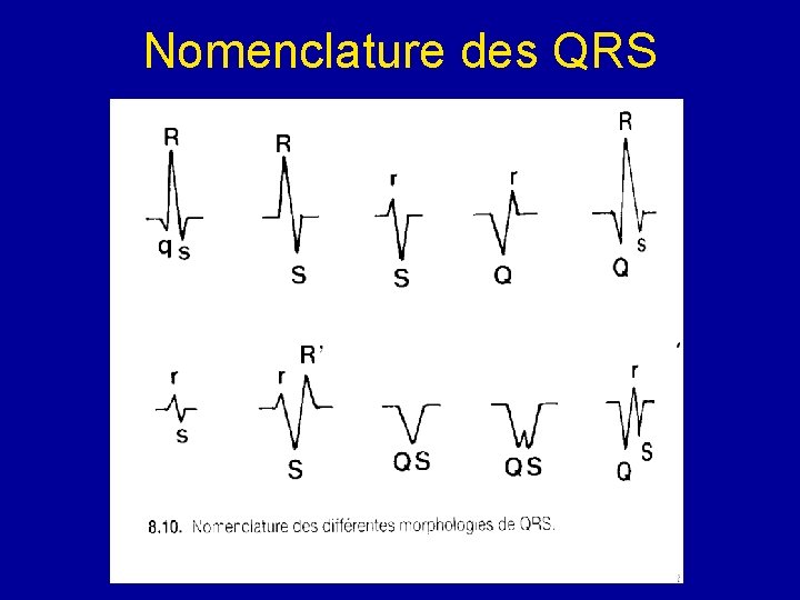 Nomenclature des QRS 