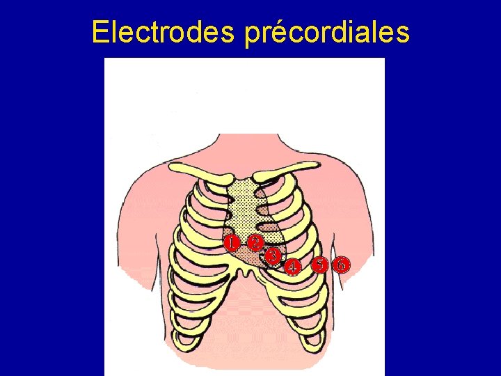 Electrodes précordiales 