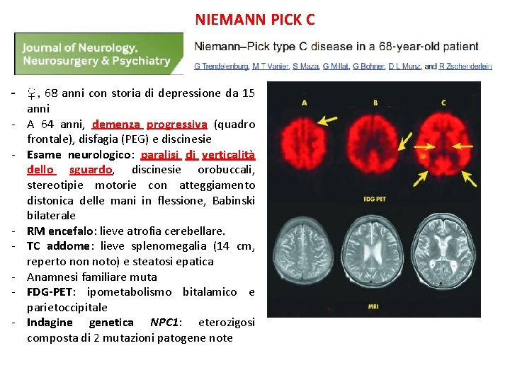 NIEMANN PICK C - ♀, 68 anni con storia di depressione da 15 anni NIEMANN PICK C - ♀, 68 anni con storia di depressione da 15 anni