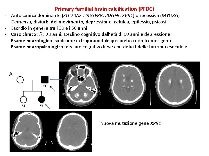 - Primary familial brain calcification (PFBC) Autosomica dominante (SLC 20 A 2 , PDGFRB, - Primary familial brain calcification (PFBC) Autosomica dominante (SLC 20 A 2 , PDGFRB,