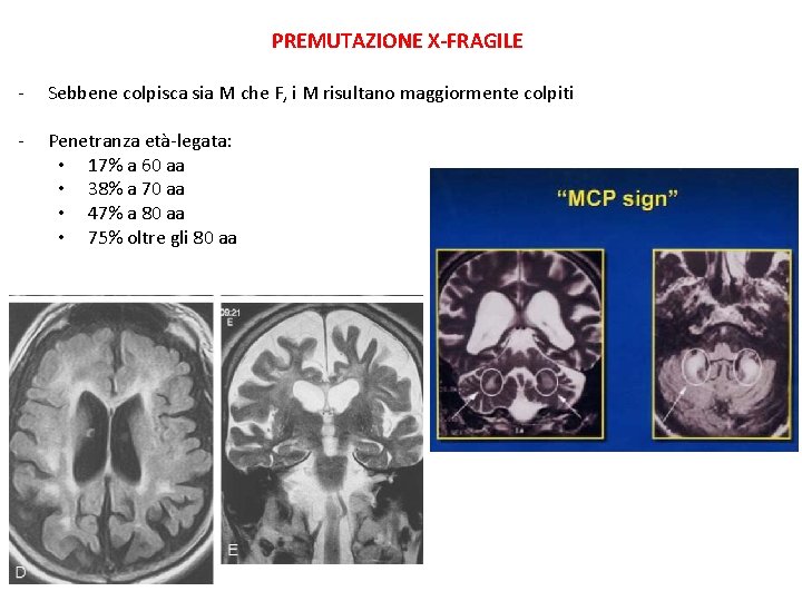 PREMUTAZIONE X-FRAGILE - Sebbene colpisca sia M che F, i M risultano maggiormente colpiti PREMUTAZIONE X-FRAGILE - Sebbene colpisca sia M che F, i M risultano maggiormente colpiti