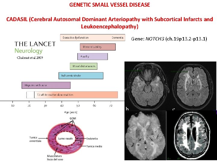 GENETIC SMALL VESSEL DISEASE CADASIL (Cerebral Autosomal Dominant Arteriopathy with Subcortical Infarcts and Leukoencephalopathy) GENETIC SMALL VESSEL DISEASE CADASIL (Cerebral Autosomal Dominant Arteriopathy with Subcortical Infarcts and Leukoencephalopathy)