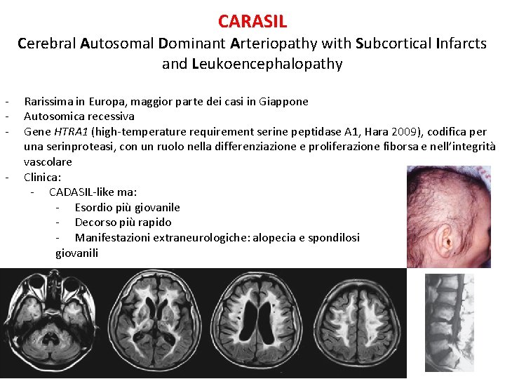 CARASIL Cerebral Autosomal Dominant Arteriopathy with Subcortical Infarcts and Leukoencephalopathy - Rarissima in Europa, CARASIL Cerebral Autosomal Dominant Arteriopathy with Subcortical Infarcts and Leukoencephalopathy - Rarissima in Europa,