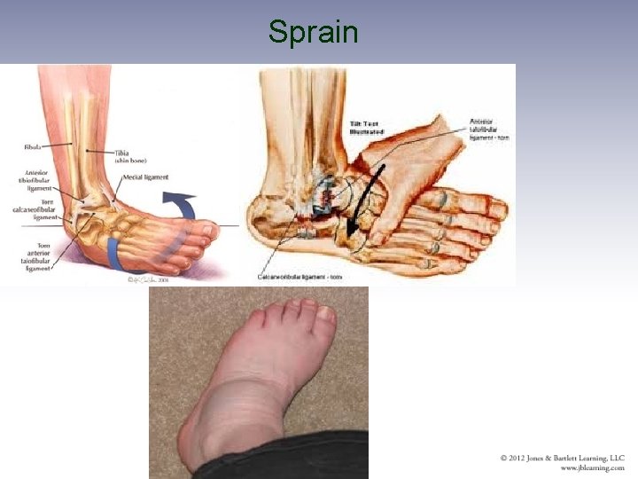 Sprain 