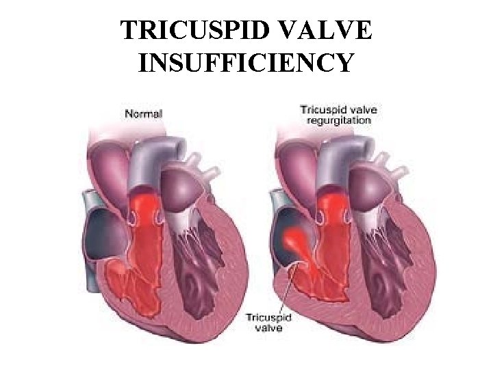 TRICUSPID VALVE INSUFFICIENCY 